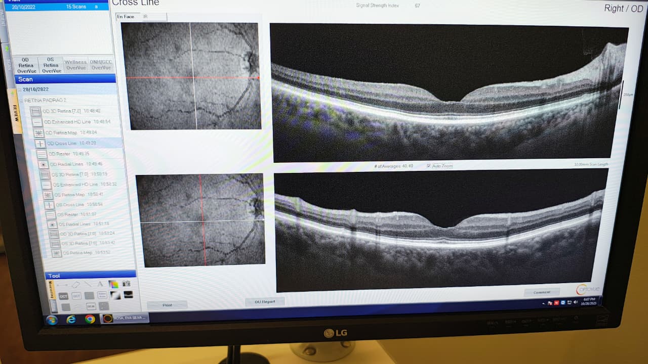 OCT ANGIOVUE - OPTOVUE